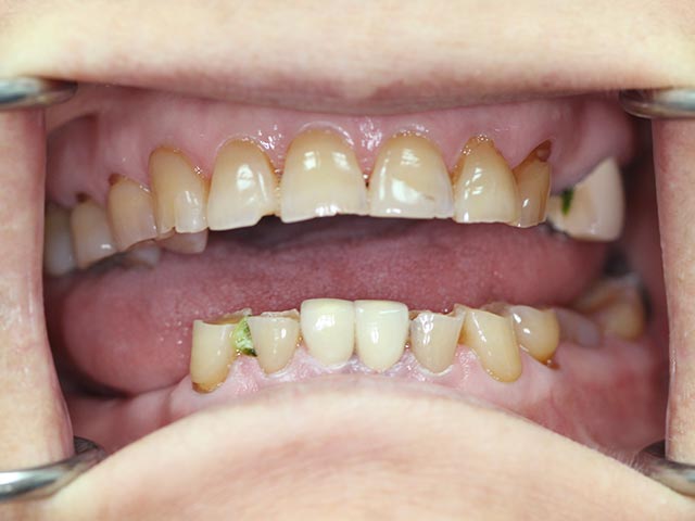 Full Mouth Reconstruction before