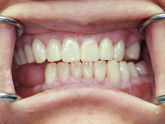 Full Mouth Reconstruction after