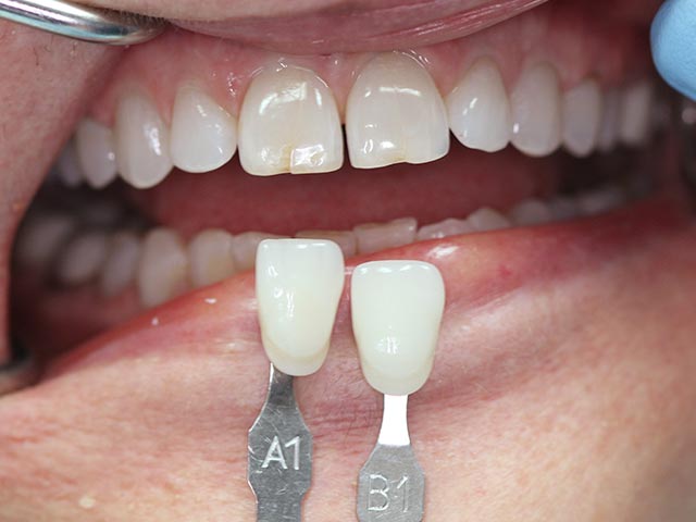 Esthetic Restoration before