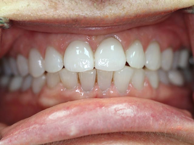 Esthetic Restoration after