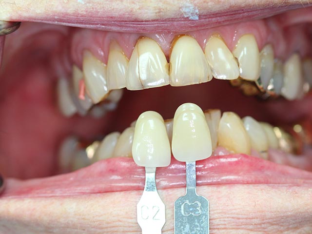 Esthetic crown before