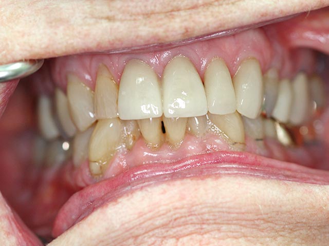 Esthetic crown after