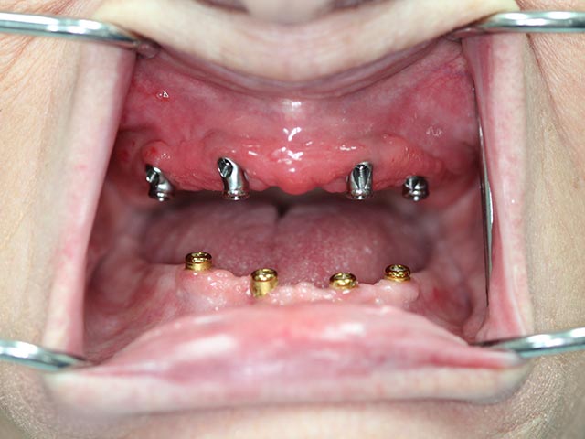 Implant Assisted Overdenture before