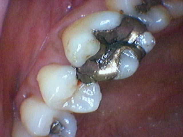 Esthetic Restoration before