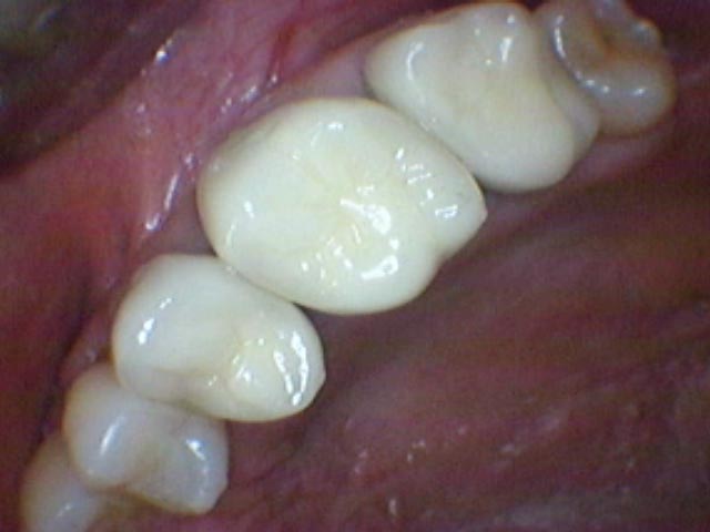 Esthetic Restoration after