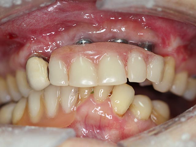 Implant Surgery before