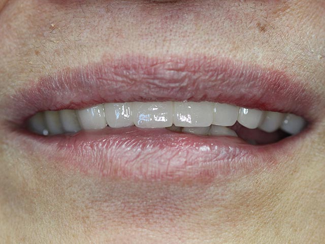 Implant Surgery after