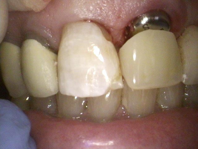 Esthetic Restoration before