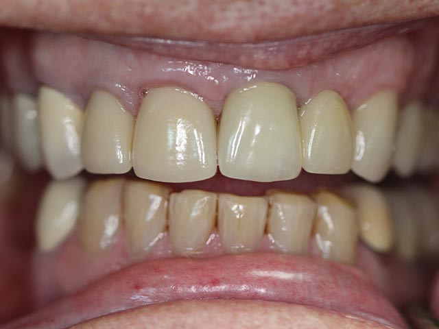 Esthetic Restoration after