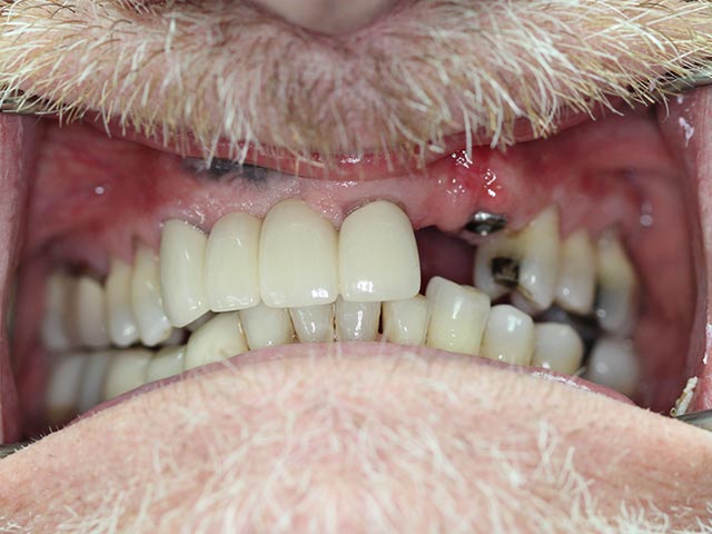 Immediate Implant Placement & Restoration before