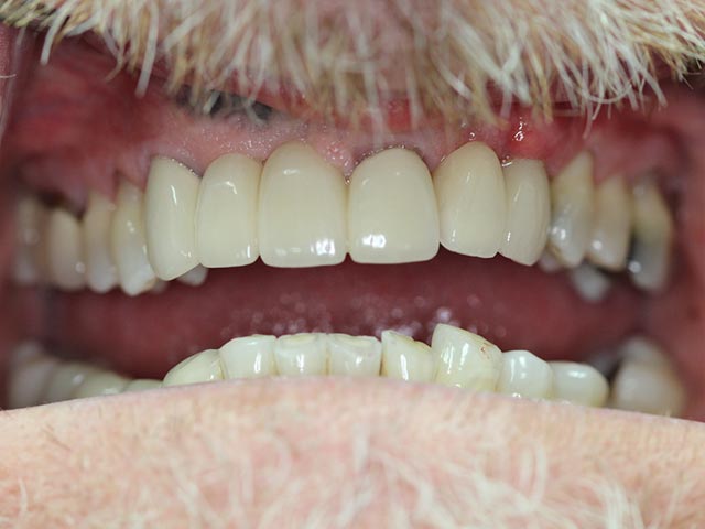 Immediate Implant Placement & Restoration after