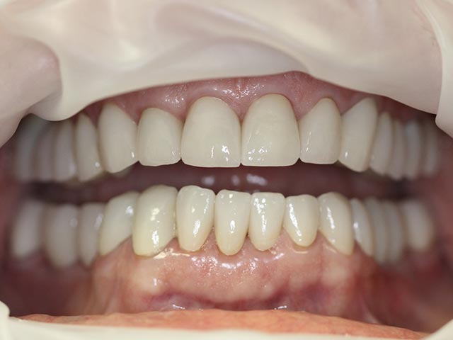 Full Mouth Reconstruction after