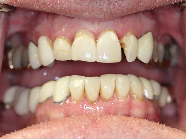 Full Mouth Reconstruction before